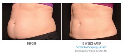 Coolsculpting Abdomen Dr Biesman