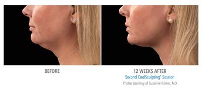 Coolsculpting Submentum, Photo Dr. Kilmer