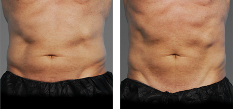 CoolTone Toned Abs Transformation 2