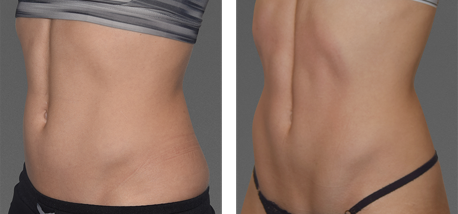 CoolTone Toned Abs Transformation 3