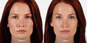 JUVÉDERM® Ultra XC before and after