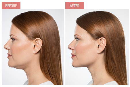 Kybella-Before-after