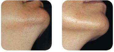 LightSheer-laser hair removal chin before and after - Courtesy of Campos V., M.D.