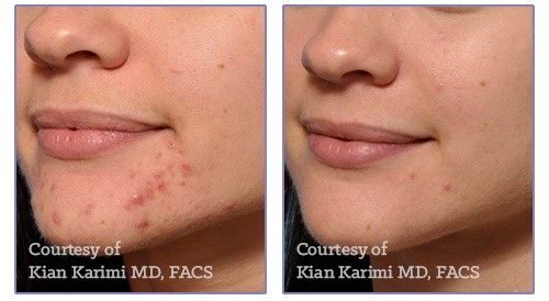 MicroNeedling Before and After