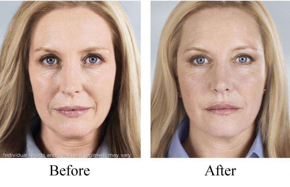 Sculptra Before and After