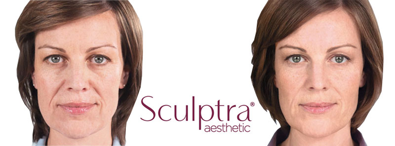 Sculptra Before and After