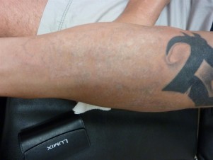 Tattoo Removal - After