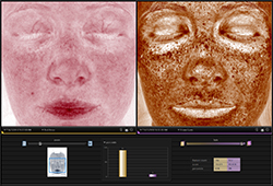 visia side by side comparisions